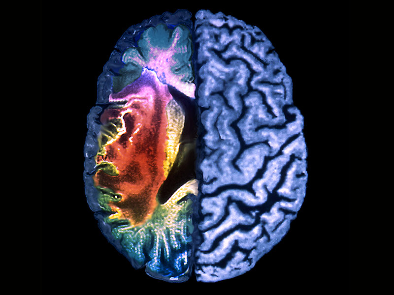 Εγκεφαλικό: Τι είναι – Συμπτώματα – Αντιμετώπιση